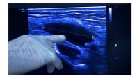 Gloved clinician's hand points at enhanced ultrasound image